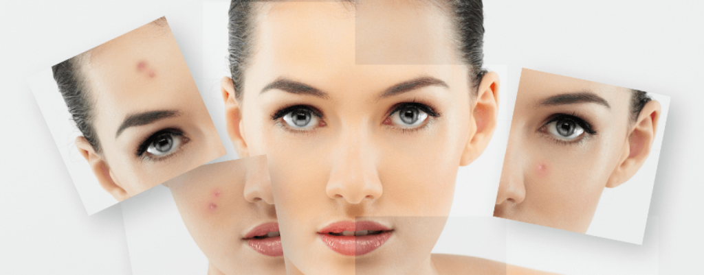 Cómo cuidar la piel grasa, mixta y con acnéCómo cuidar la piel grasa, mixta y con acné